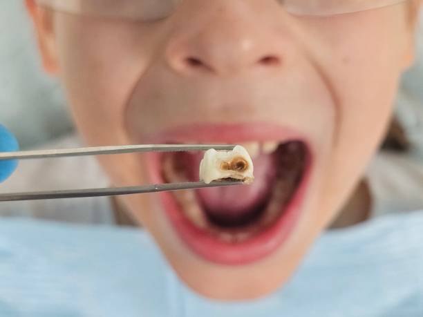 Best Emergency Treatment for Toothache in Yalaha, FL
